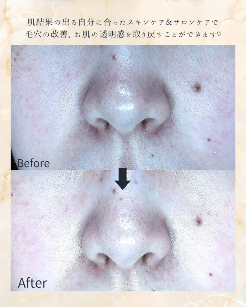 毛穴開き、透明感アップ　ビフォーアフター🍋