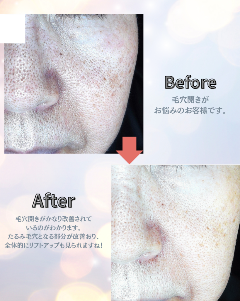お肌のビフォーアフター 〜毛穴開き・赤み〜