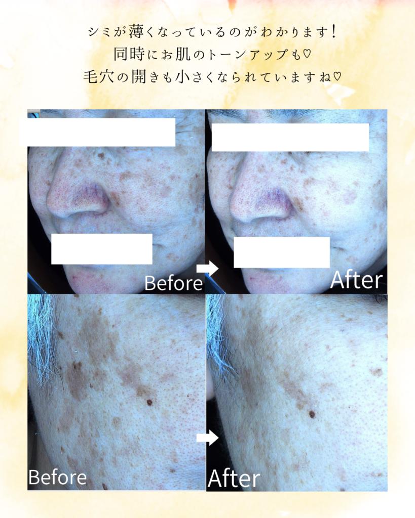 シミ、トーンアップのビフォーアフター